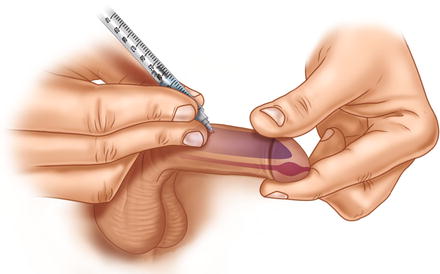 Saline Penis Injection